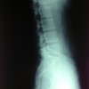 lumbar-straight