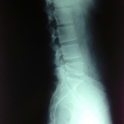 lumbar-straight