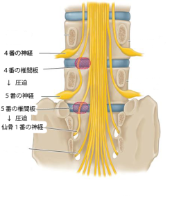 Disc_herniation