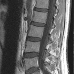 My Lumbar Spine